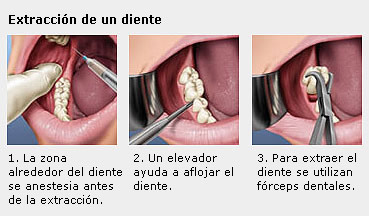 Infografia de extracción de un diente