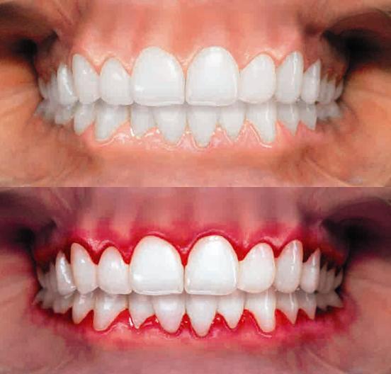 Comparación de dientes sanos