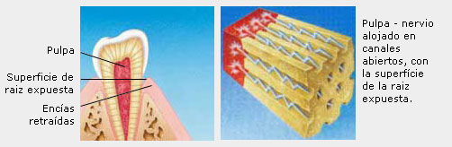 Pulpa, raíz y encías
